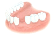 Teeth implantation permits to save the adjacent teeth